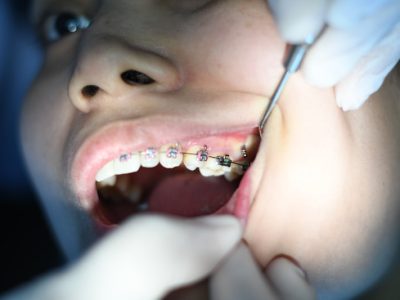 Dental SEO - patient with dental braces