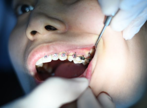 Dental SEO - patient with dental braces